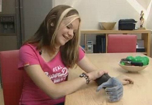 Esta chica de 15 años ya cuenta con su prótesis biónica