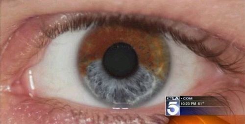 Nuevo procedimiento láser transforma ojos marrones en ojos azules